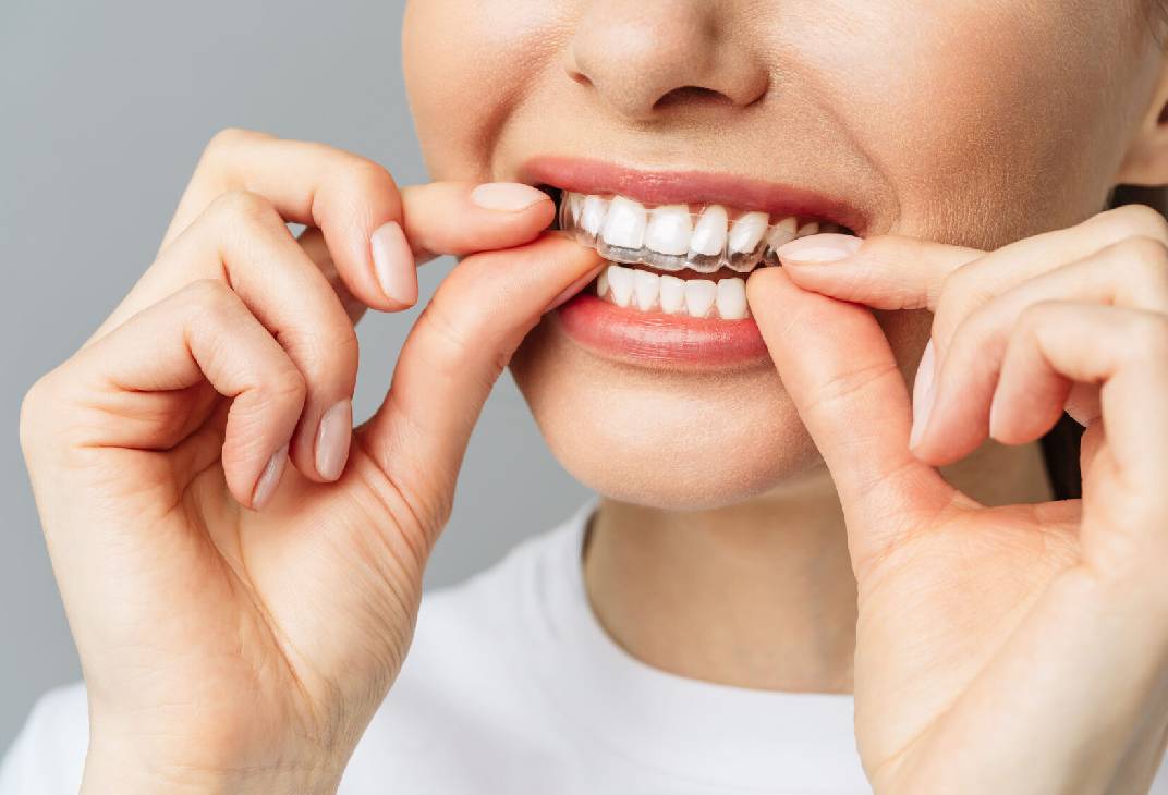 Invisalign Aligners
